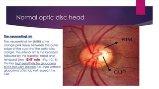Gonioscopy and optic nerve head evaluation | PPTX