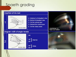 Comprehensive Guide to Gonioscopy: Techniques, Interpretation, and ...