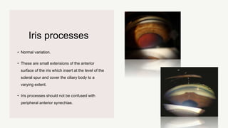 Iris processes
• Normal variation.
• These are small extensions of the anterior
surface of the iris which insert at the level of the
scleral spur and cover the ciliary body to a
varying extent.
• Iris processes should not be confused with
peripheral anterior synechiae.
 