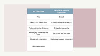 Iris Processes
Peripheral Anterior
Synechiae
Fine Broad
Extend into scleral spur Extend beyond scleral spur
Follow concavity of recess Bridge the concavity
Underlying structures are
seen
Structures are not seen
Moves with indentation Stationary - resists movement
Normal variation
 