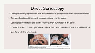 • Direct gonioscopy is performed with the patient in a supine position under topical anaesthsia.
• The goniolens is positioned on the cornea using a coupling agent.
• Gonioscope in one hand and a light source(Barkan illuminator) in the other.
• Gonioscope with mounted light source may be used, which allows the examiner to control the
goniolens with the other hand.
Direct Gonioscopy
 