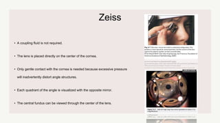 Zeiss
• A coupling fluid is not required.
• The lens is placed directly on the center of the cornea.
• Only gentle contact with the cornea is needed because excessive pressure
will inadvertently distort angle structures.
• Each quadrant of the angle is visualized with the opposite mirror.
• The central fundus can be viewed through the center of the lens.
 