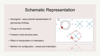 Schematic Representation
• Goniogram - easy pictorial representation of
gonioscopy findings.
• Things to be recorded -
• Posterior most structure seen.
• Effect of manipulation or indentation.
• Mention iris configuration , recess and indentation.
 