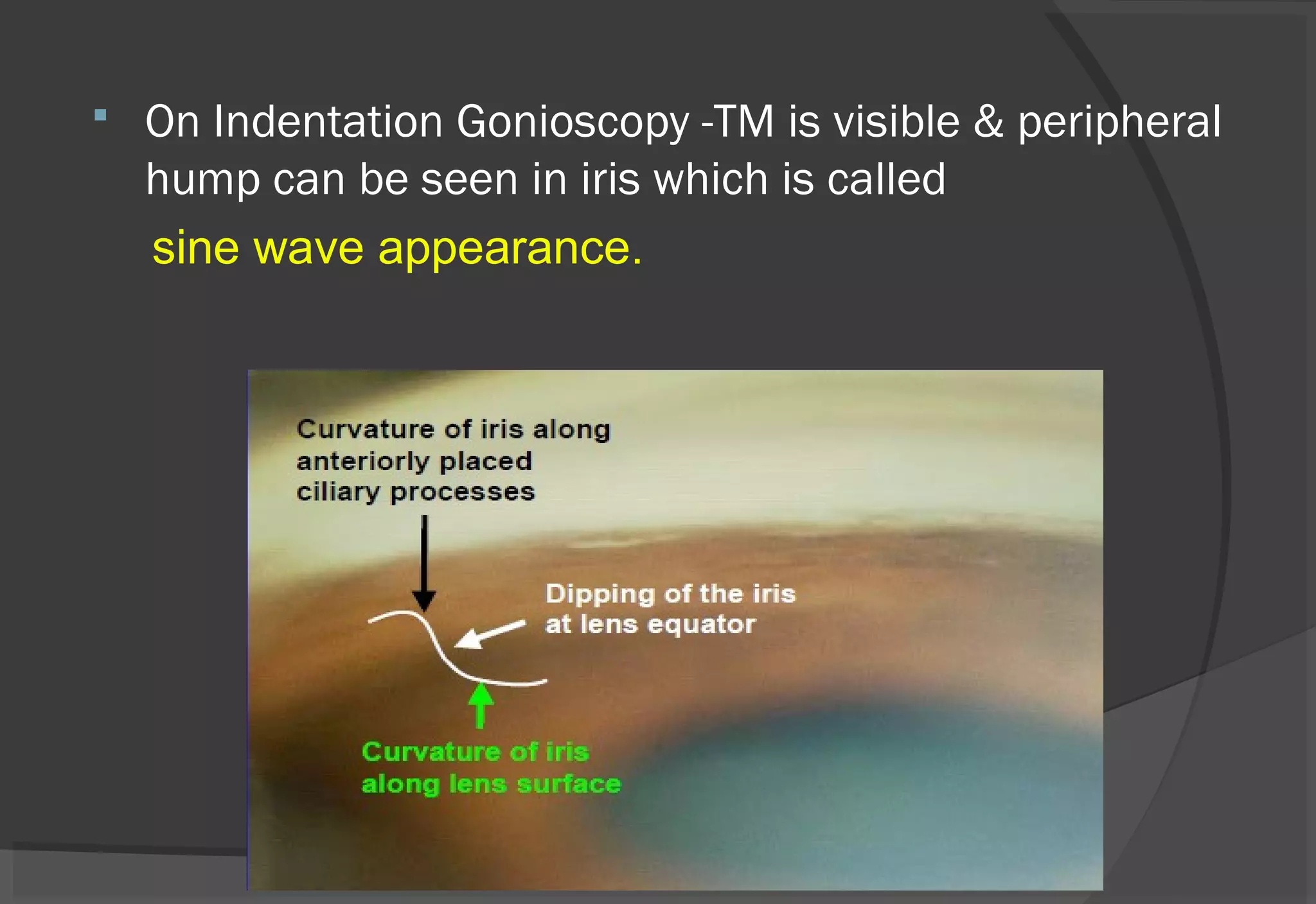 On Indentation Gonioscopy -TM is visible & peripheral
hump can be seen in iris which is called
sine wave appearance.
 