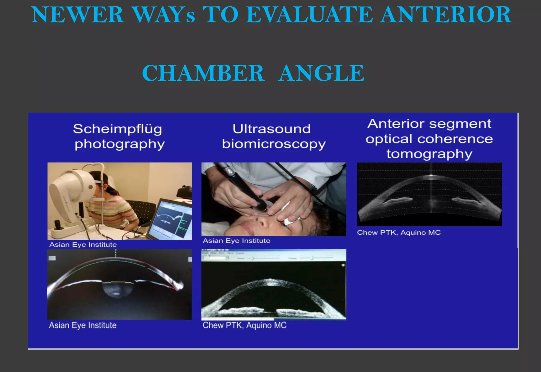 NEWER WAYs TO EVALUATE ANTERIOR
CHAMBER ANGLE
 