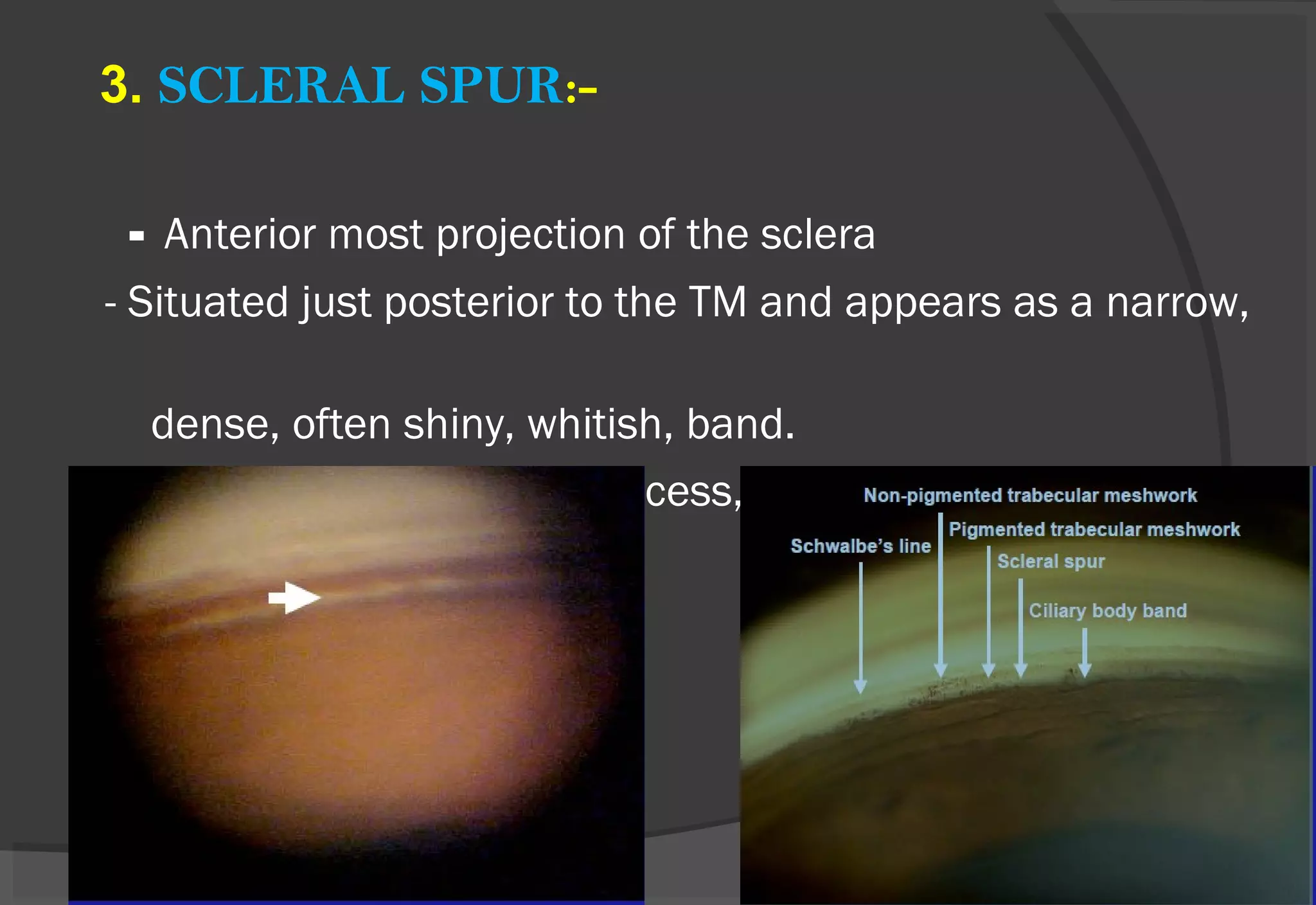 3. SCLERAL SPUR:-
- Anterior most projection of the sclera
- Situated just posterior to the TM and appears as a narrow,
dense, often shiny, whitish, band.
-May be obscured by iris process, and pigments.
 