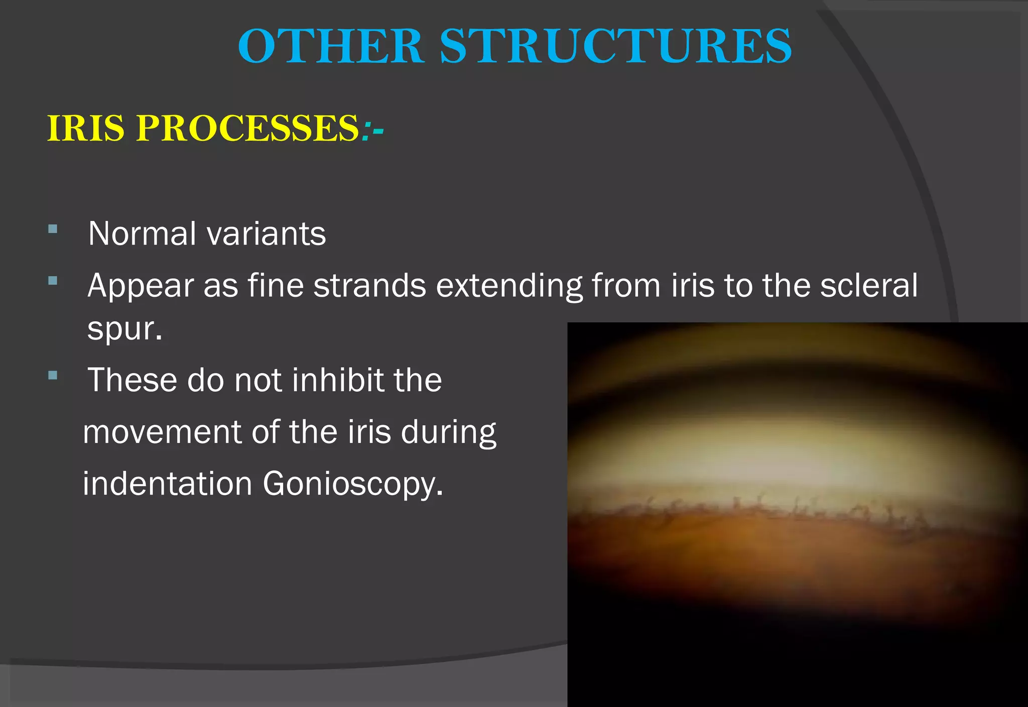 OTHER STRUCTURES
IRIS PROCESSES:-
 Normal variants
 Appear as fine strands extending from iris to the scleral
spur.
 These do not inhibit the
movement of the iris during
indentation Gonioscopy.
 