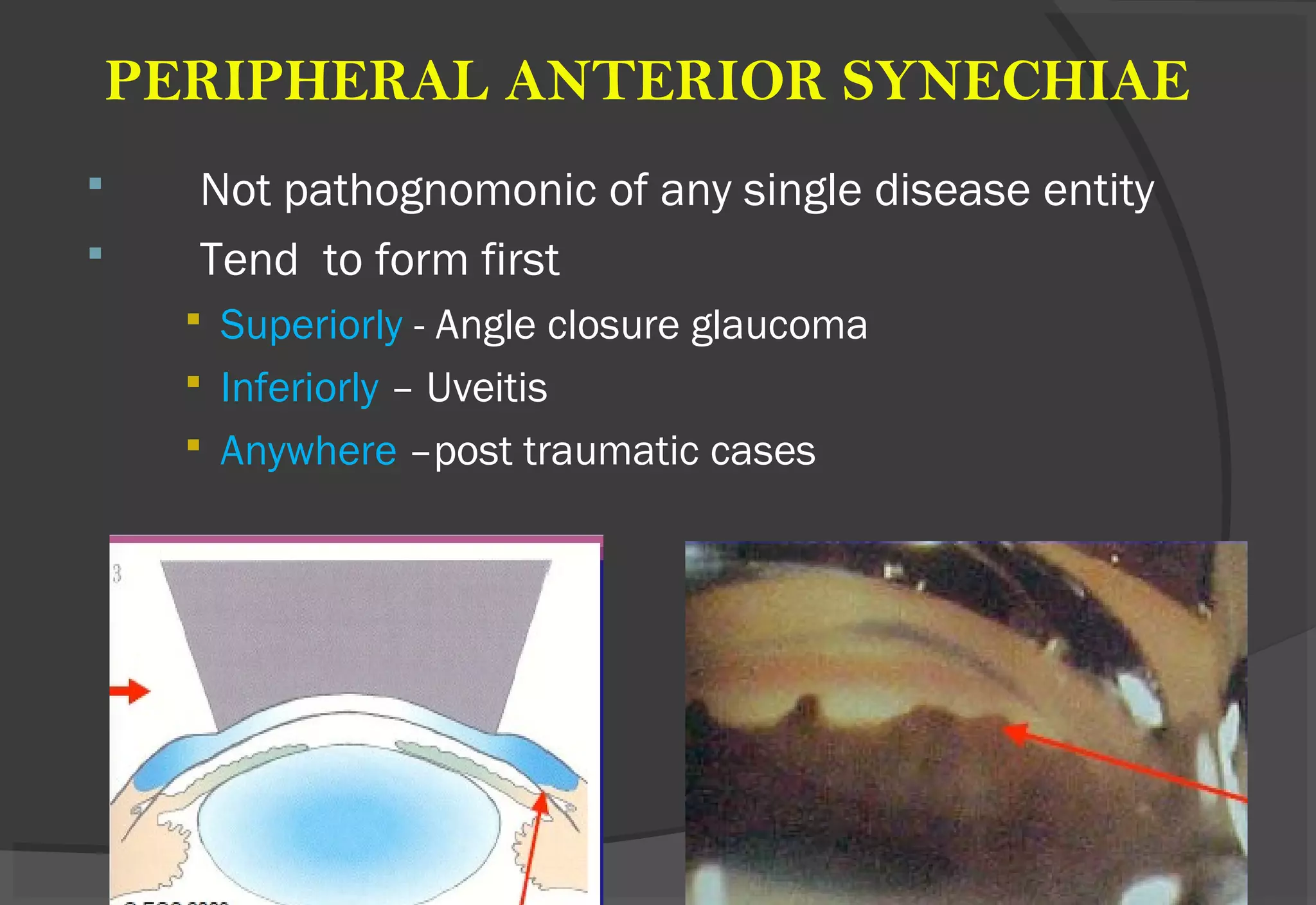 PERIPHERAL ANTERIOR SYNECHIAE
 Not pathognomonic of any single disease entity
 Tend to form first
 Superiorly - Angle closure glaucoma
 Inferiorly – Uveitis
 Anywhere –post traumatic cases
 