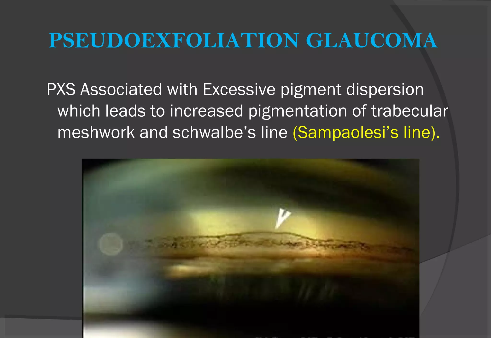 PSEUDOEXFOLIATION GLAUCOMA
PXS Associated with Excessive pigment dispersion
which leads to increased pigmentation of trabecular
meshwork and schwalbe’s line (Sampaolesi’s line).
 