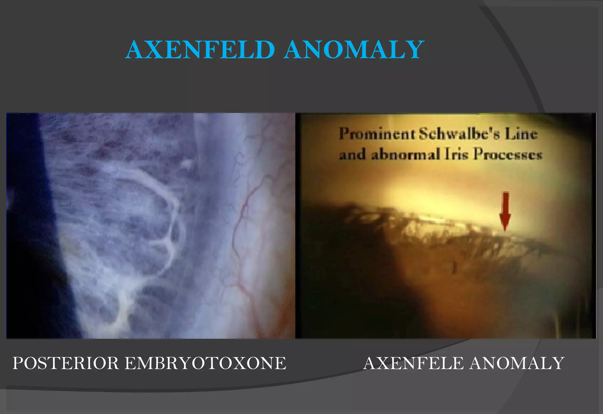 POSTERIOR EMBRYOTOXONE AXENFELE ANOMALY
AXENFELD ANOMALY
 