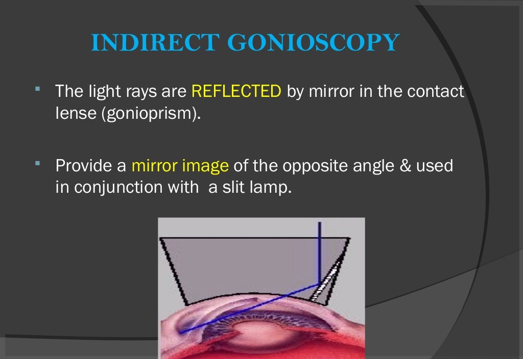 GONIOSCOPY