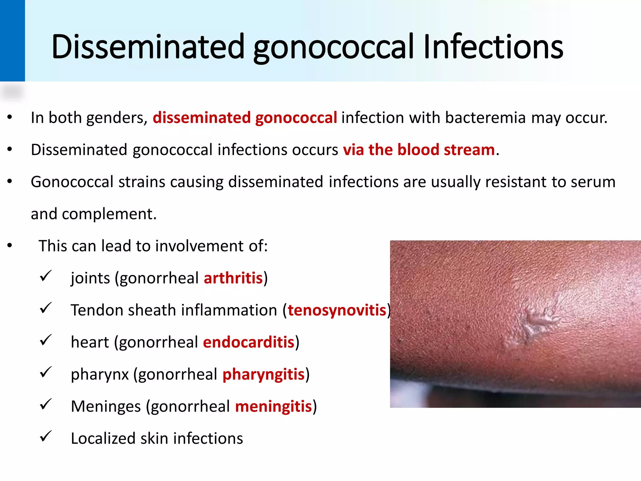 Gonococci | PDF