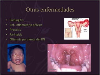 Otras enfermedades
•   Salpingitis
•   Enf. Inflamatoria pélvica
•   Proctitis
•   Faringitis
•   Oftalmía purulenta del RN
 