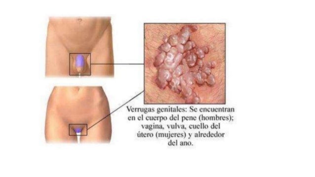 Resultado de imagen para gonorrea