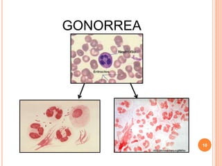 GONORREA
10
 