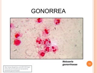 GONORREA
13
http://www.blogichics.com/2013/01/gon
orrea-ets-provocada-por-la-bacteria-
neisseria-gonorrhoeae/
Neisseria
gonorrhoeae
 