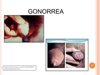 GONORREA
17
Fuente: http://drmauro.com/43-GONORREA-
O-BLENORRAGIA.html
 