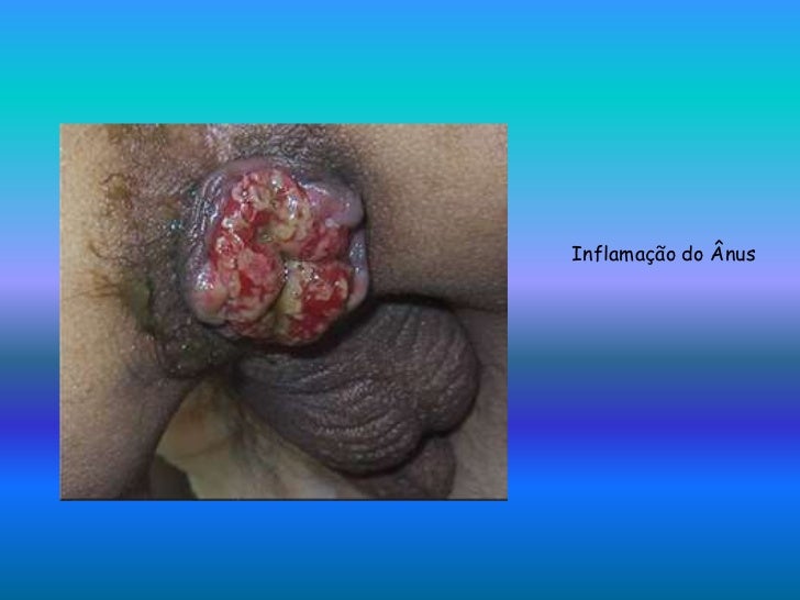 anus herpes images #11