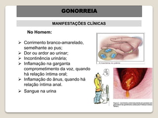 No Homem:
 Corrimento branco-amarelado,
semelhante ao pus;
 Dor ou ardor ao urinar;
 Incontinência urinária;
 Inflamação na garganta
comprometimento da voz, quando
há relação íntima oral;
 Inflamação do ânus, quando há
relação íntima anal.
 Sangue na urina
GONORREIA
MANIFESTAÇÕES CLÍNICAS
GONORREIA
 