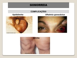 GONORREIA
COMPLICAÇÕES
Epididimite
Artrite
medicinanet.com
Oftalmia gonocócica
medicinanet.com
wikipedia.com.br
 