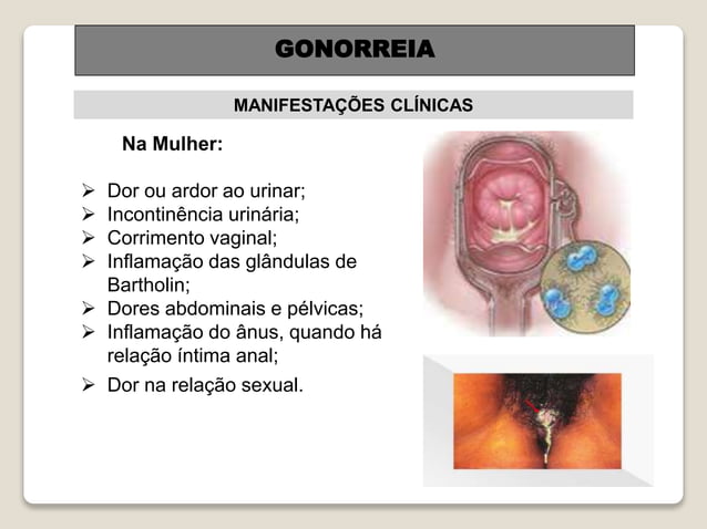Gonorreia