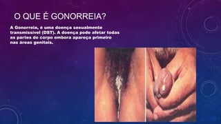 O QUE É GONORREIA?
A Gonorreia, é uma doença sexualmente
transmissível (DST). A doença pode afetar todas
as partes do corpo embora apareça primeiro
nas áreas genitais.
 