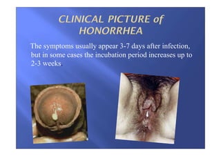 The symptoms usually appear 3-7 days after infection,
but in some cases the incubation period increases up to
2-3 weeks.
 