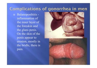 Balanoposthitis -
inflammation of
the inner layer of
the foreskin and
the glans penis.
On the skin of the
penis appear to
erosion, mostly in
the bridle, there is
pain.
 