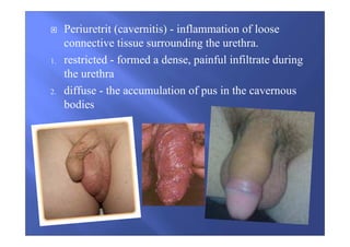 Periuretrit (cavernitis) - inflammation of loose
connective tissue surrounding the urethra.
1. restricted - formed a dense, painful infiltrate during
the urethra
2. diffuse - the accumulation of pus in the cavernous
bodies
 