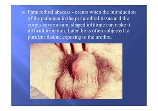 Paraurethral abscess - occurs when the introduction
of the pathogen in the periurethral tissue and the
corpus cavernosum, shaped infiltrate can make it
difficult urination. Later, he is often subjected to
purulent fusion, exposing to the urethra.
 