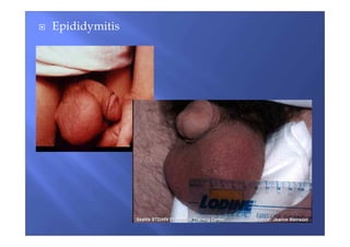 Epididymitis
 