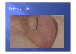 Epididymitis
 