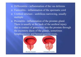 Differentitis - inflammation of the vas deferens
Funiculitis - inflammation of the spermatic cord
Urethral stricture - umbilicus narrowing, usually
multiple
Prostatitis - inflammation of the prostate gland.
There is usually at the back of the urethral injury
due to contact of gonococci into the prostate through
the excretory ducts of the glands, sometimes
lymphogenous and hematogenous route.
 