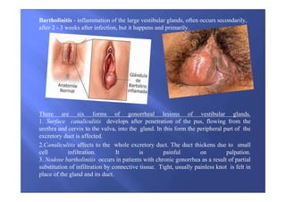Bartholinitis - inflammation of the large vestibular glands, often occurs secondarily,
after 2 - 3 weeks after infection, but it happens and primarily.
There are six forms of gonorrheal lesions of vestibular glands.
1. Surface canaliculitis develops after penetration of the pus, flowing from the
urethra and cervix to the vulva, into the gland. In this form the peripheral part of the
excretory duct is affected.
2.Сanaliculitis affects to the whole excretory duct. The duct thickens due to small
cell infiltration. It is painful on palpation.
3. Nodose bartholinitis occurs in patients with chronic gonorrhea as a result of partial
substitution of infiltration by connective tissue. Tight, usually painless knot is felt in
place of the gland and its duct.
 