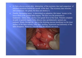 4. False abscess occurs after obstruction of the excretory duct and congestion of
purulent secretions behind the mouth of the duct. The excretory duct stretches
and compresses the gland, but does not destroy it.
Painful, fluctuating tumor is determined on palpation, this tumor locates in the
lower third of the genital labia majora. The skin over the protrusion is
hyperemic . Quite often can be a low-grade fever of the body. Patients complain
on pain in genital organs. False abscess may spontaneously opened, pus
contents breaks through the duct or the thinning mucous membrane on the inner
surface of the labia minora. After that, swelling, hyperemia and deformity of the
labia disappear. However, over the time the disease can recur.
 