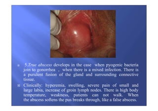 5.True abscess develops in the case when pyogenic bacteria
join to gonorrhea , when there is a mixed infection. There is
a purulent fusion of the gland and surrounding connective
tissue.
Clinically: hyperemia, swelling, severe pain of small and
large labia, increase of groin lymph nodes. There is high body
temperature, weakness, patients can not walk. When
the abscess softens the pus breaks through, like a false abscess.
 