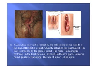 6. Excretory duct cyst is formed by the obliteration of the outside of
the duct of Bartholin’s gland, when the infection has disappeared. The
duct is stretched by the gland’s secret. The part of labia majora
protrudes in the localization of affected Bartholin’s gland. Tumor is
round, painless, fluctuating. The size of tumor is like a pea.
 