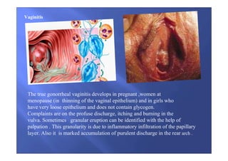 Vaginitis
The true gonorrheal vaginitis develops in pregnant ,women at
menopause (in thinning of the vaginal epithelium) and in girls who
have very loose epithelium and does not contain glycogen.
Complaints are on the profuse discharge, itching and burning in the
vulva. Sometimes granular eruption can be identified with the help of
palpation . This granularity is due to inflammatory infiltration of the papillary
layer. Also it is marked accumulation of purulent discharge in the rear arch .
 