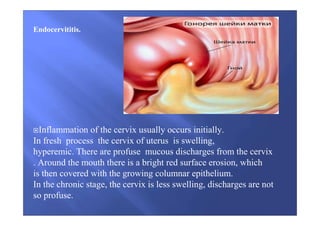 Endocervititis.
Inflammation of the cervix usually occurs initially.
In fresh process the cervix of uterus is swelling,
hyperemic. There are profuse mucous discharges from the cervix
. Around the mouth there is a bright red surface erosion, which
is then covered with the growing columnar epithelium.
In the chronic stage, the cervix is ​​less swelling, discharges are not
so profuse.
 