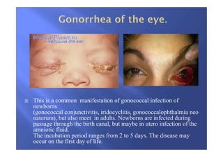 This is a common manifestation of gonococcal infection of
newborns
(gonococcal conjunctivitis, iridocyclitis, gonococcalophthalmia neo
natorum), but also meet in adults. Newborns are infected during
passage through the birth canal, but maybe in utero infection of the
amniotic fluid.
The incubation period ranges from 2 to 5 days. The disease may
occur on the first day of life.
 