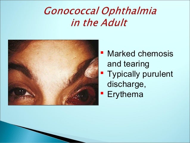 Gonorrhea