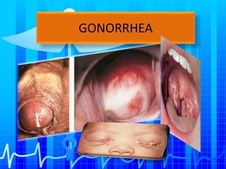 GONORRHEA
 