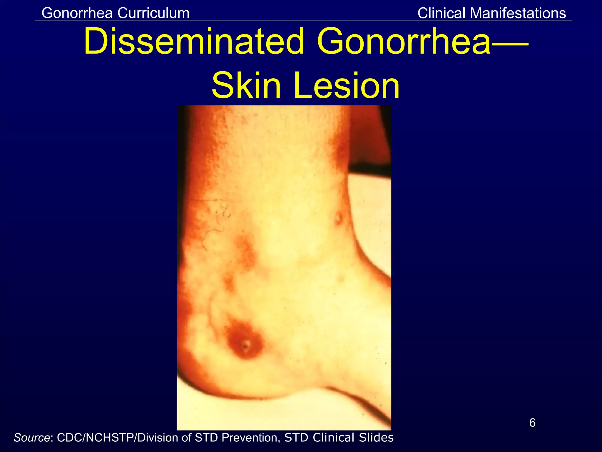 Gonorrhea slides | PPT