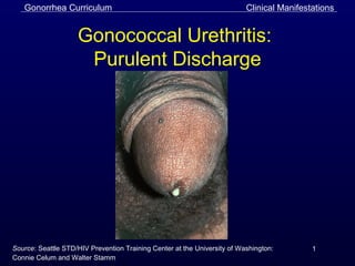 Gonorrhea Curriculum
1
Gonococcal Urethritis:
Purulent Discharge
Clinical Manifestations
Source: Seattle STD/HIV Prevention Training Center at the University of Washington:
Connie Celum and Walter Stamm
 