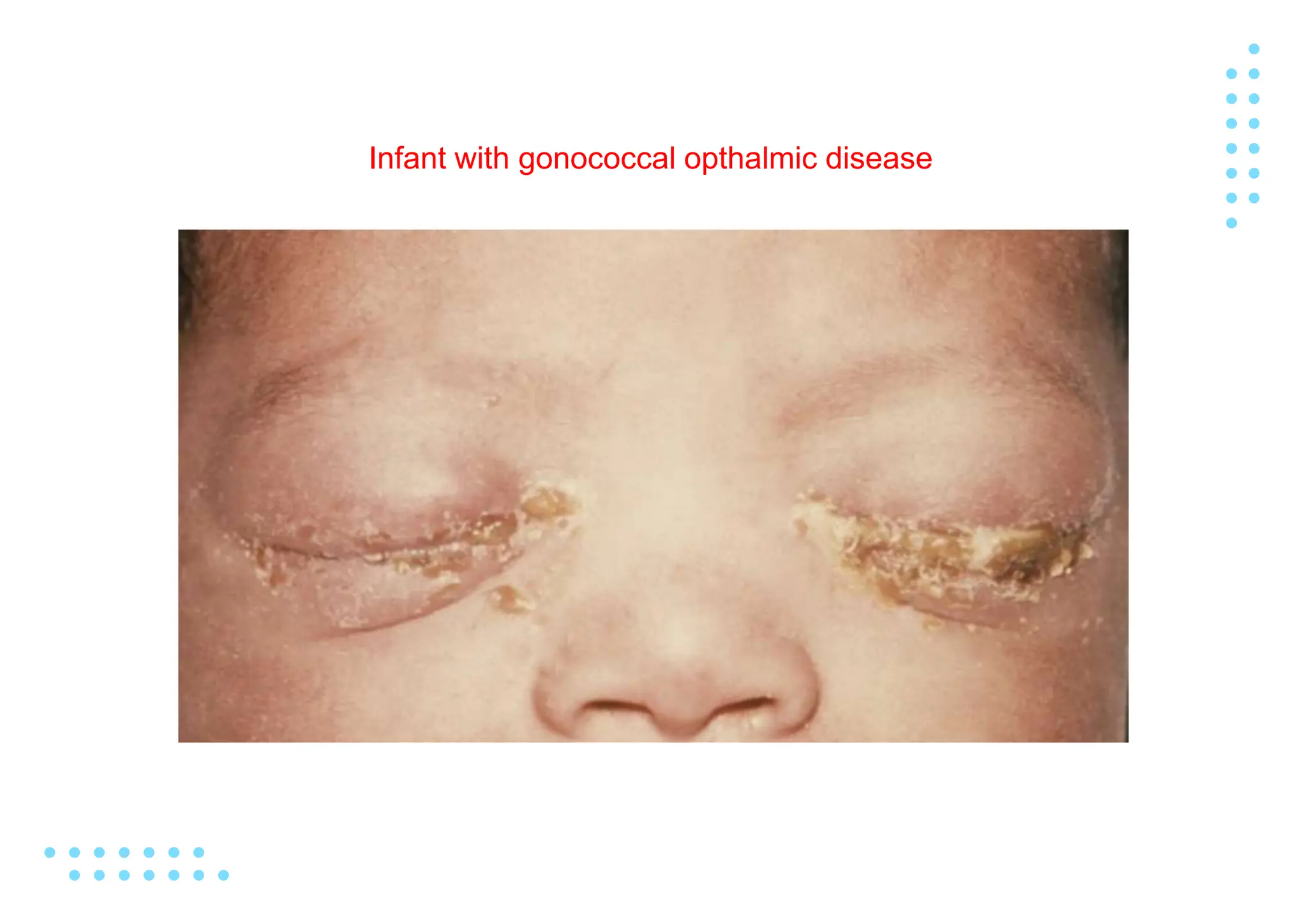 Gonorrhea Edited.pptx , Neisseria gonorrhoeae or gonococcus | PPTX