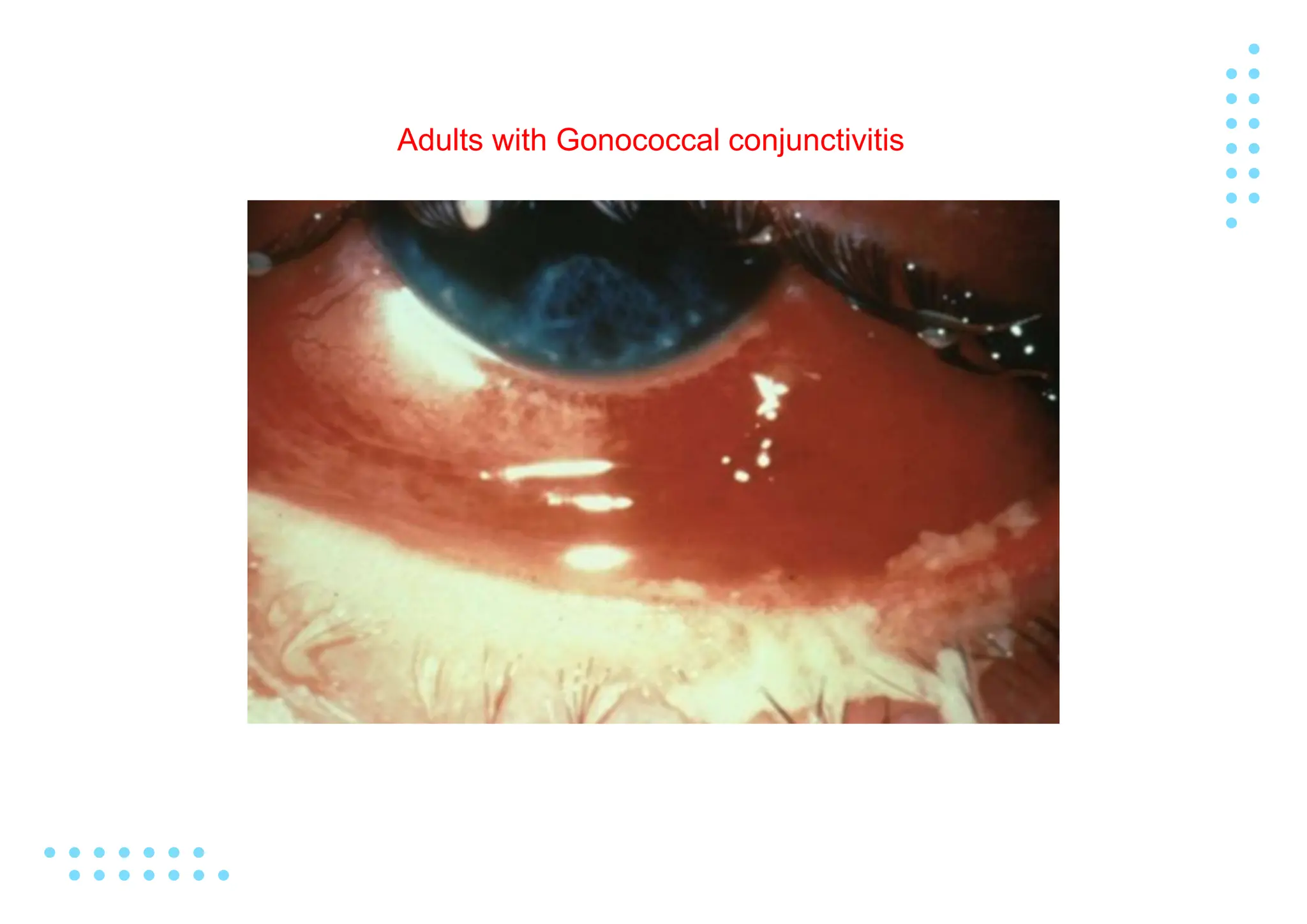 Gonorrhea Edited.pptx , Neisseria gonorrhoeae or gonococcus | PPTX