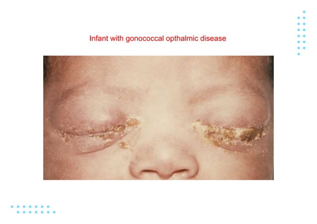 Gonorrhea Edited.pptx , Neisseria gonorrhoeae or gonococcus | PPTX ...