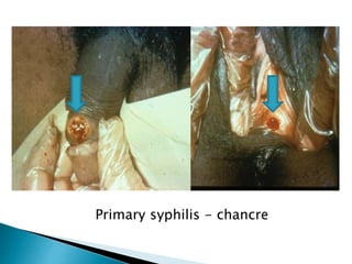 Primary syphilis - chancre
 