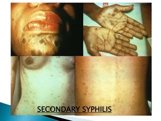 SECONDARY SYPHILIS
 