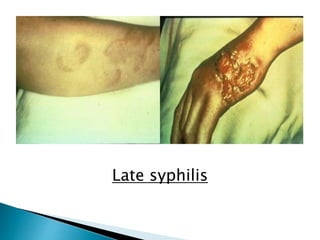 Late syphilis
 